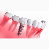 Установка сучасного зубного імпланта з наданням гарантії